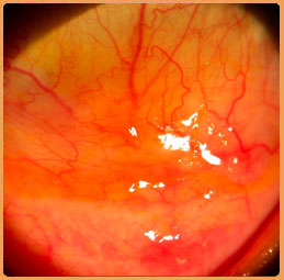 OCULAR INFLAMMATION - DARSHAN EYE CARE