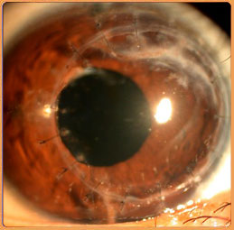 CORNEAL TRANSPLANTS IN CHILDREN - DARSHAN EYE CARE