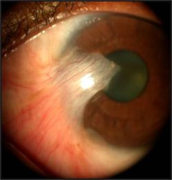 Tips For Cataract Surgery In Eyes With Compromised Endothelium