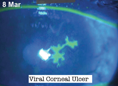 corneal_ulcer