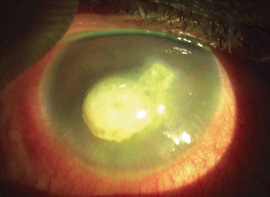 corneal_ulcer_a