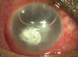 corneal_ulcer_b