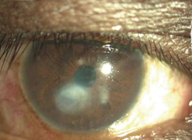 corneal_ulcer_c