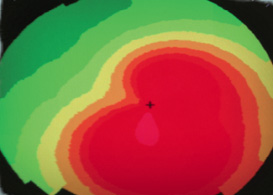 keratoconus_a