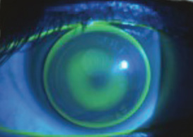 keratoconus_c