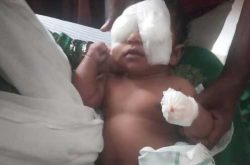 Cataract Surgery In Both Eyes In a 2-month-old Baby