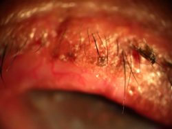 Clinical Challenges-Ocular Allergy