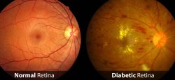 Clinical Challenges-Diabetic Eye Disease