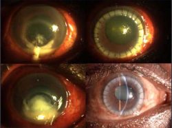 Clinical Challenges-Corneal Infections