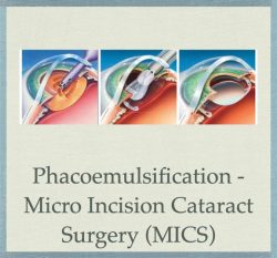 Phacoemulsification – Micro Incision Cataract Surgery (MICS)