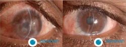 Ocular Surface Reconstruction Surgery