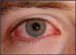 The Pink Eye Apocalypse -epidemic Keratoconjuctivitis