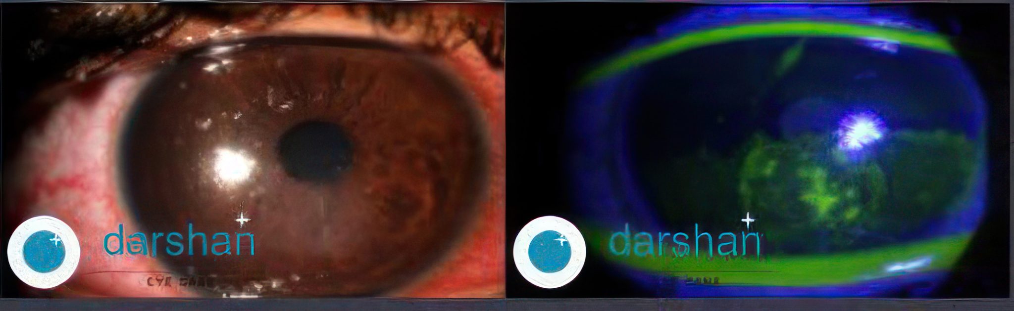 Recurrent Corneal Erosion Syndrome Rces Darshan Eye Care