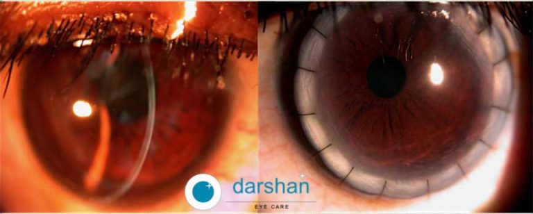 Deep Anterior Lamellar Keratoplasty Dalk Darshan Eye Care