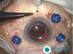 Sutureless Retinal Surgery