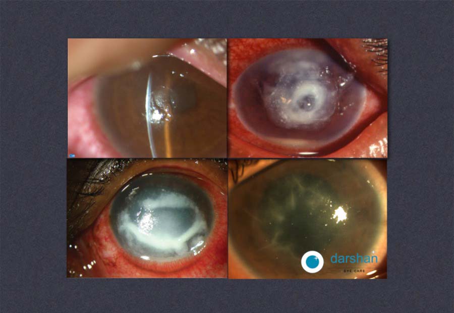 Contact Lens Induced Corneal Infections
