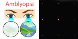 AMBLYOPIA (LAZY EYE)