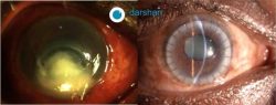 Corneal Infections