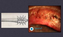 ﻿Lid Margin Disease- Demodex Folliculitis