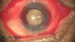 Band Shaped Keratopathy