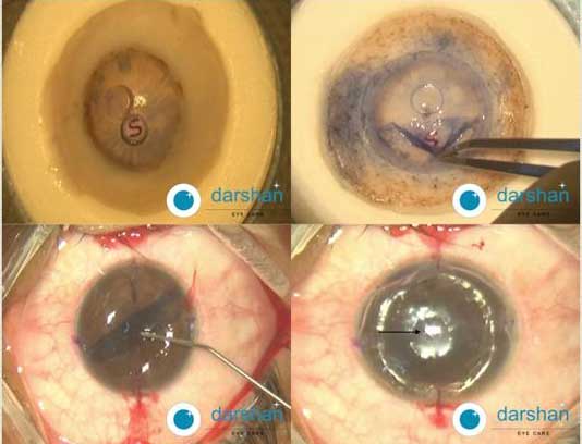 Descemet Membrane Endothelial Keratoplasty (DMEK)