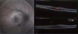 Central Serous Chorioretinopathy (CSCR)