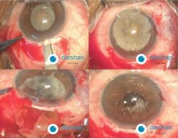 Small Incision Cataract Surgery (SICS)