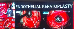 Endothelial keratoplasty outcomes