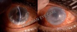 Fungal keratitis