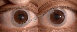 Bilateral Corneal Opacity in a 36-Year-Old lady