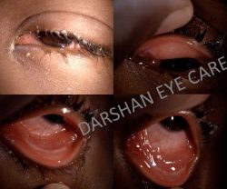 Severe Viral Conjunctivitis and Its Management
