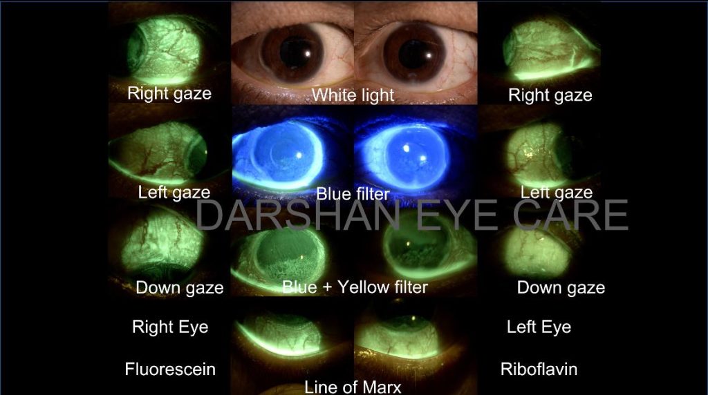 Riboflavin staining of the Ocular Surface