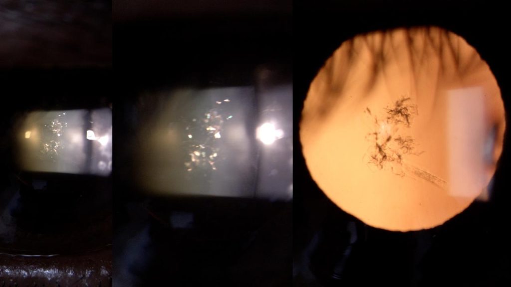 Christmas Tree Cataract – A Rare Ocular Finding