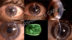 DALK: Deep Anterior Lamellar Keratoplasty