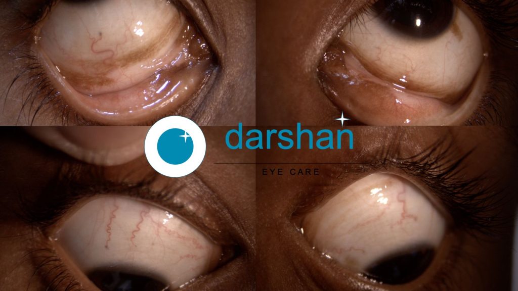 Conjunctival Melanosis