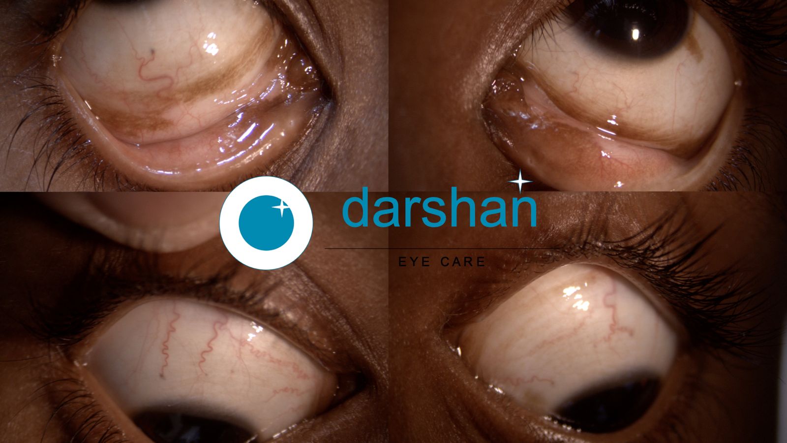 Conjunctival Melanosis