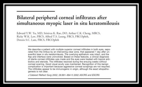 Bilateral peripheral corneal infiltrate after myopic LASIK